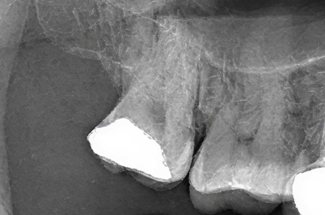 Sample periapical radiograph of teeth 1 to 3, illustrative only